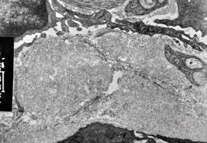 M,60y. | jejunum - amyloidosis M,60y. | jejunum - amyloidosis